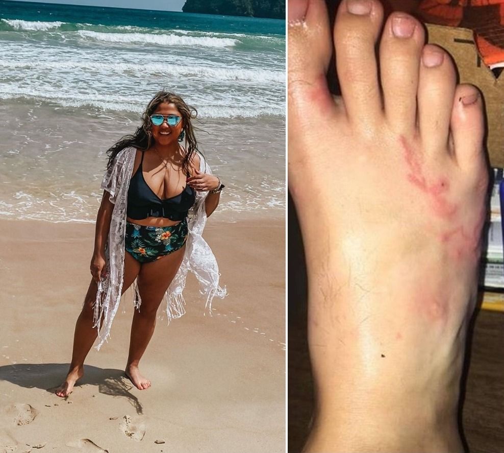 Mulher de pé descalço na praia / Pé com ancilóstomo rastejando nele